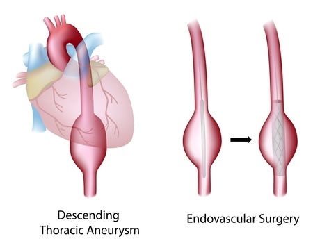 Treatment of aneurysms of the thoracic aorta