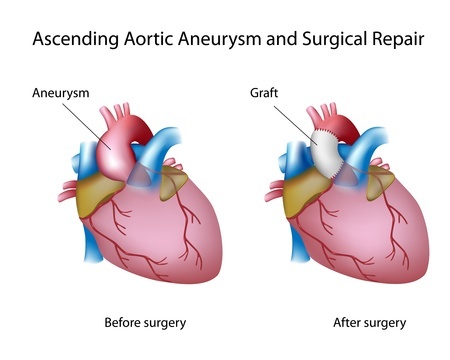 Aneurysm of the ascending aorta before and after surgery