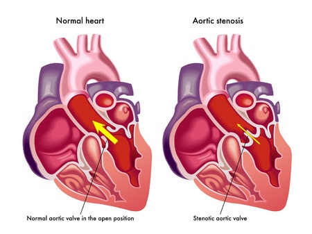 Aortic Valve Repair and Replacement - Treatment in Israel ...