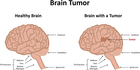 Brain tumors