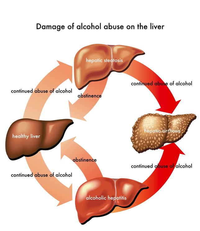 Damage of alcohol abuse on the liver