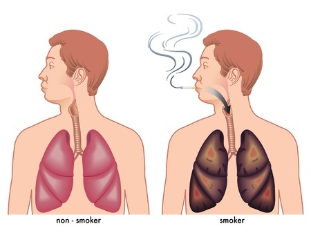 The effect of smoking on the lungs
