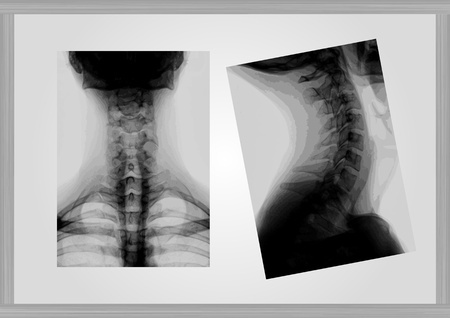 Fluoroscopic cervical