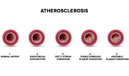 The formation of atherosclerotic plaque