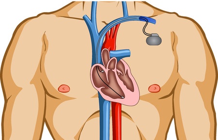 Implantation pacemaker