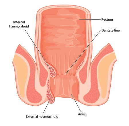 Internal and external hemorrhoids