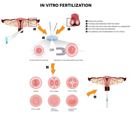 In Vitro Fertilization in Israel