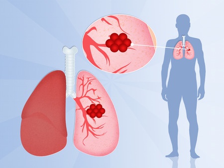 The localization of the tumor in the lung