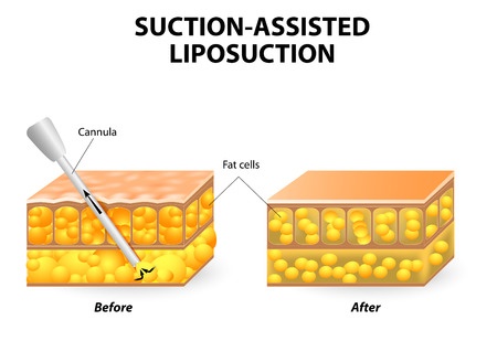 Mechanism of liposuction
