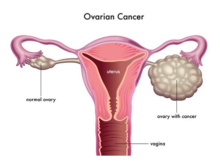 Image result for ovarian cancer