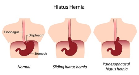 Paraesophageal hernia