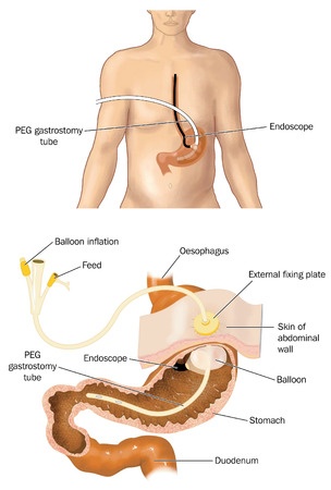 Percutaneous gastrostomy