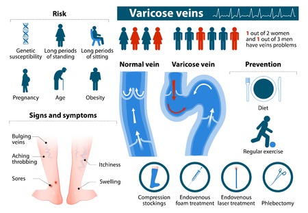 The problems of varicose veins