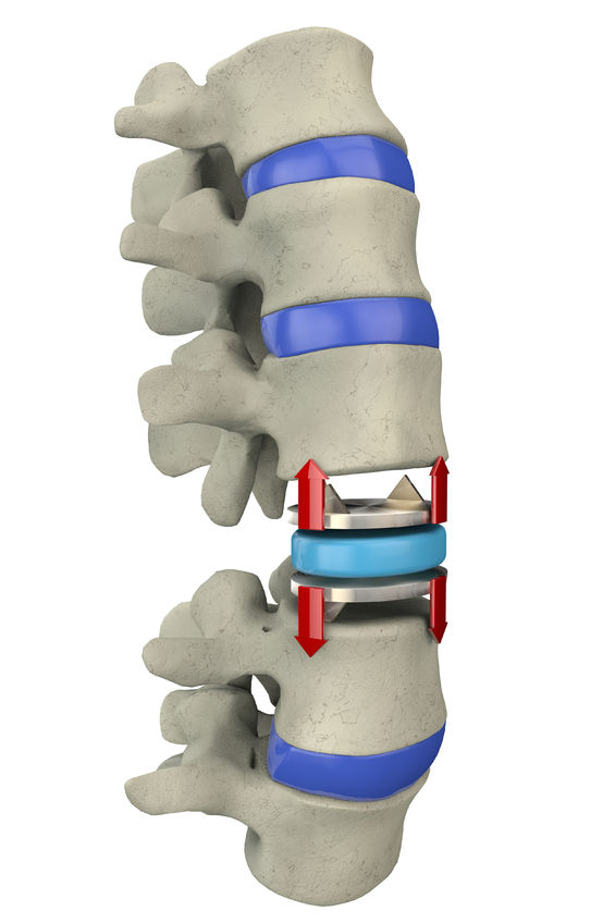 Replacement of the intervertebral disc