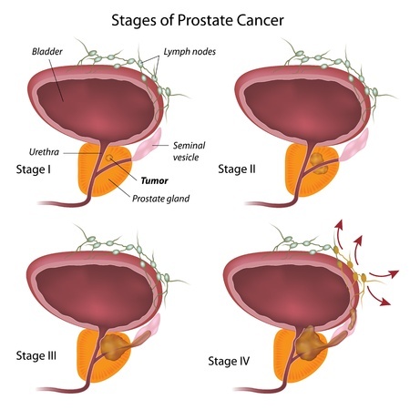 Stage prostate cancer