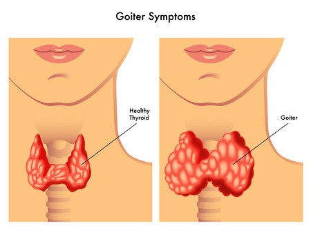 Thyroid Goiter