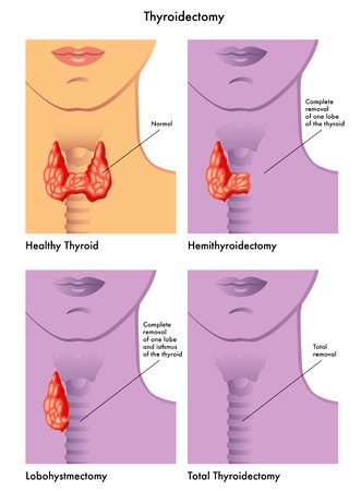 thyroidectomy surgery thyroid israel aftercare akshata