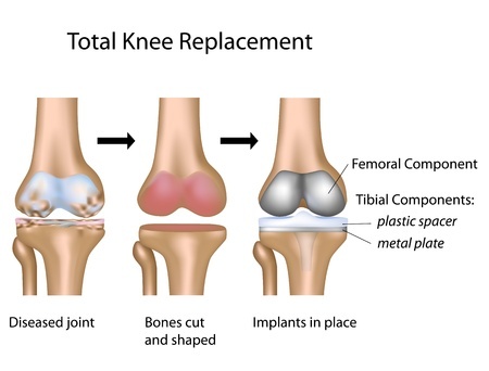 Total knee replasment