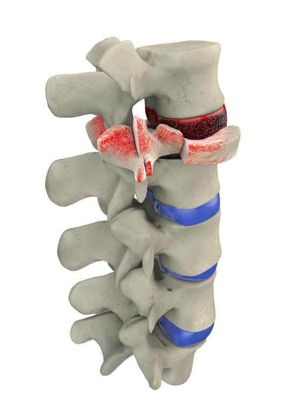 Traumatic vertebral