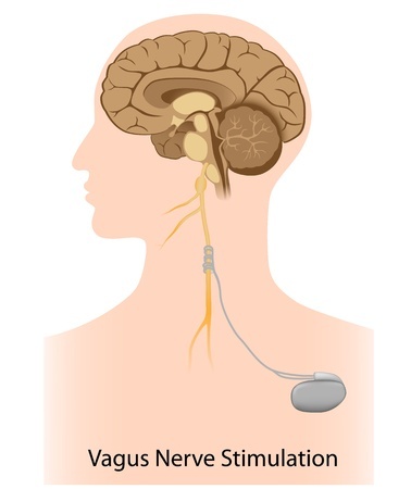 Vagus nerve Stimulation