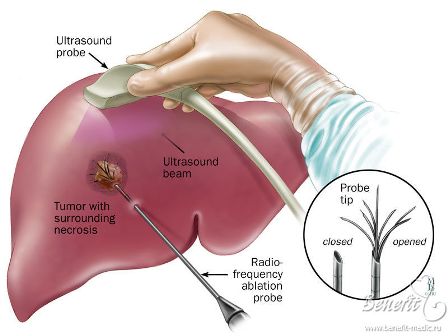 Ablation therapy