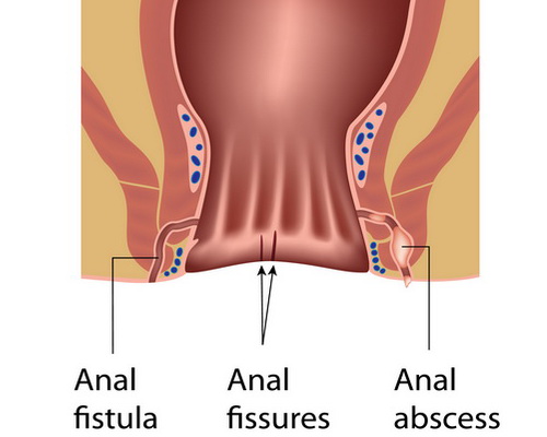 Anal fissures