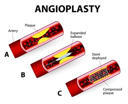 Angioplasty and stenting