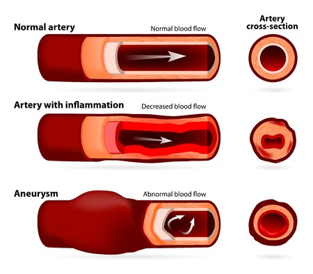 Aortic aneurysm