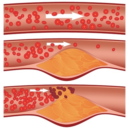 The process of arterial occlusion