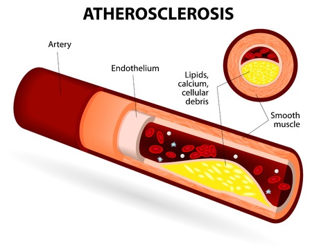 Thickening of the walls of the arteries (atherosclerosis)