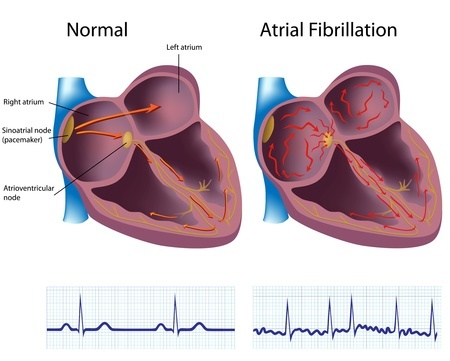  Atrial fibrillation