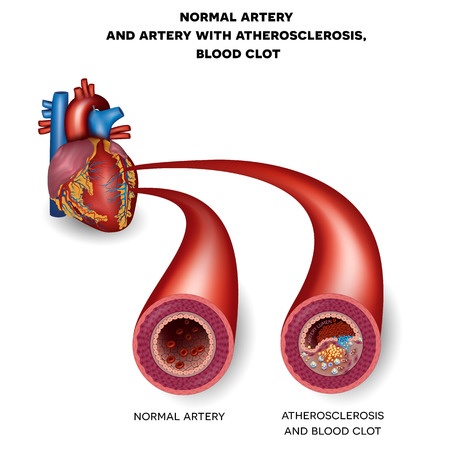 Coronary artery stenosis
