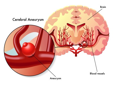 Cerebral aneurysms