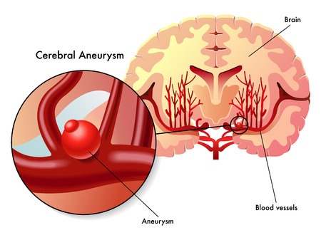 Brain Aneurysm - Treatment in Israel | D.R.A Medical