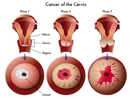 Cervical cancer