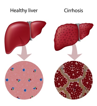 Cirrhosis