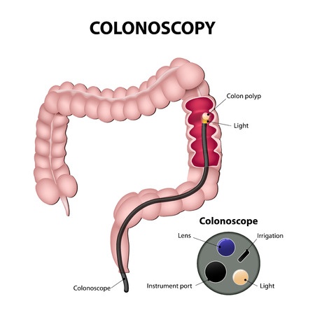 Colonoscopy for the diagnosis of irritable bowel syndrome