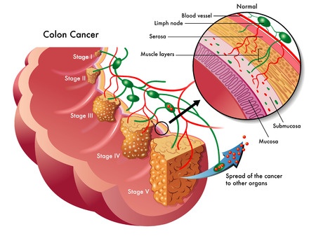 Stages of Colorectal Cancer