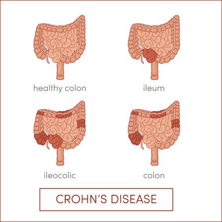 Crohn's disease