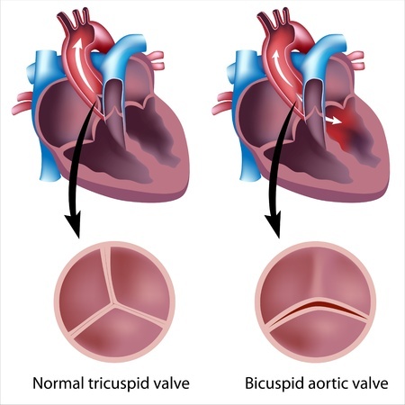 Defective heart valve