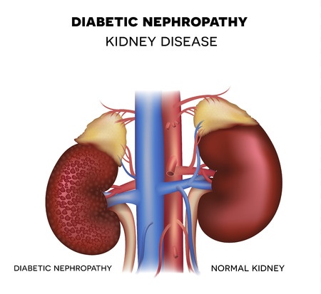 Diabetic nephropathy