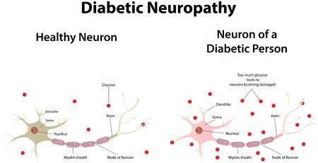 Diabetic neuropathy