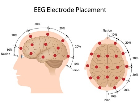 Electroencephalogram