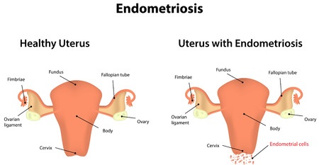 Endometriosis