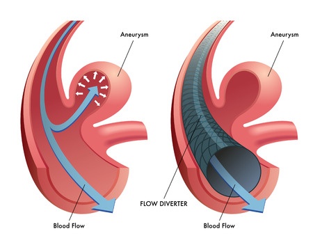 Endovascular prosthesis