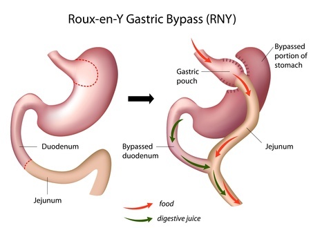 Gastric bypass surgery with anastomosis