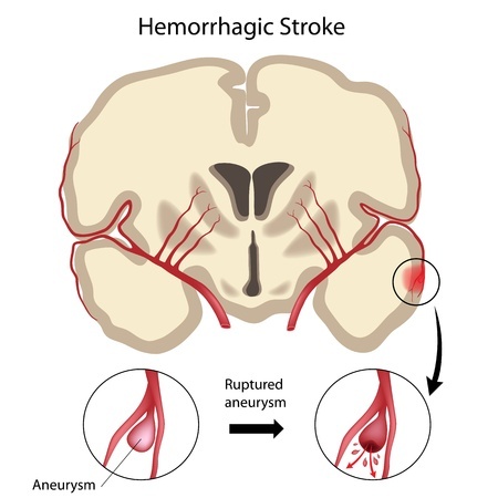 Hemorrhagic stroke