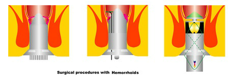 Hemorrhoid treatment