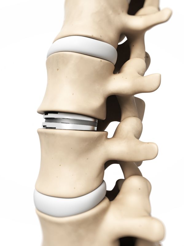 Intervertebral disc replacement