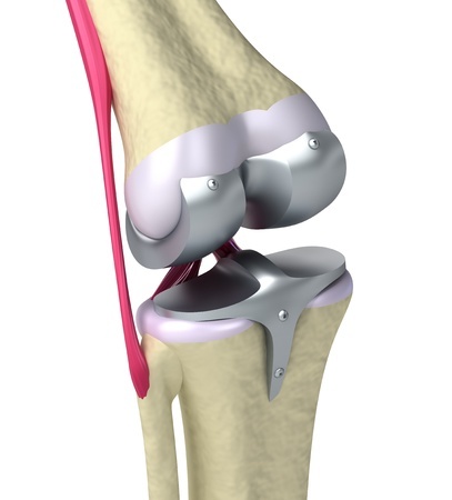 Knee prosthesis